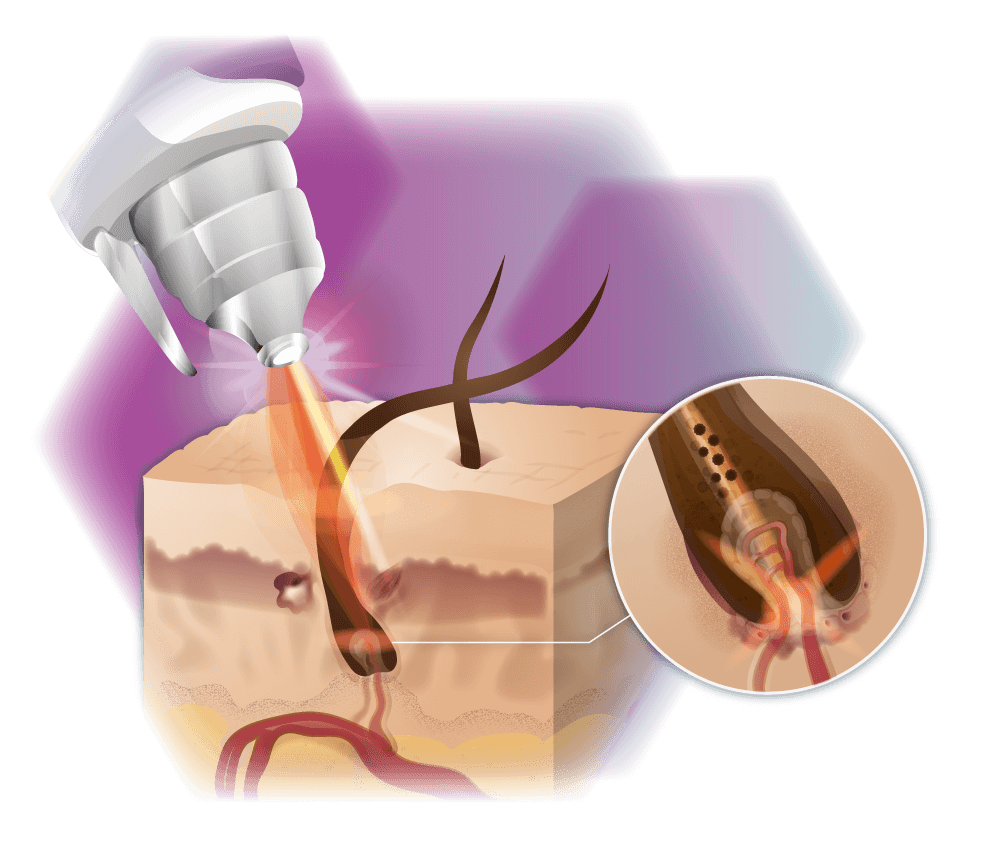 Infographic mode of action ND:YAG laser